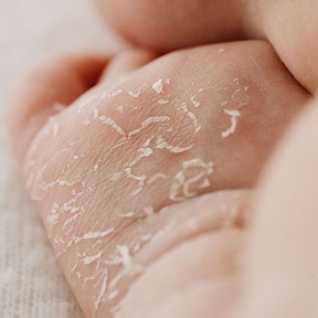 Dry skin texture